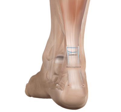 Arthrex - Implant System, PARS SutureTape - AR-8862DS